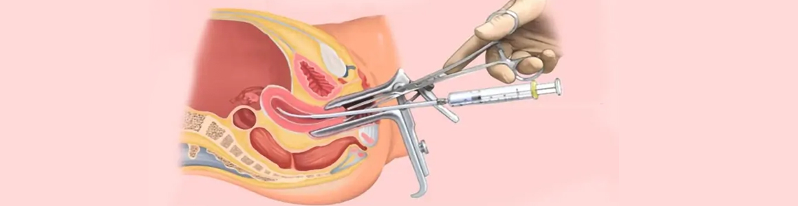 IUI - Intrauterine Insemination